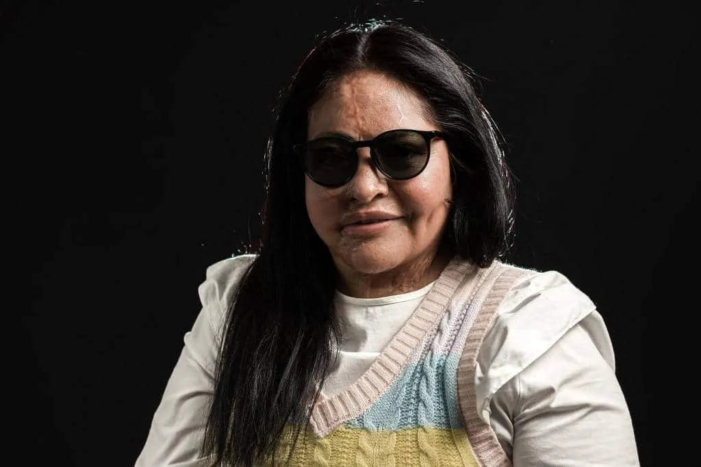Healing by helping: Mexico's acid attack victims